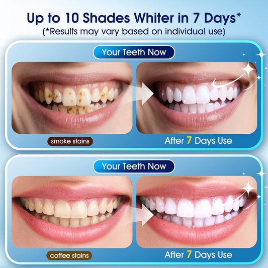 LED whitening light device included in the kit