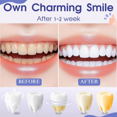 Whitening gel being applied to teeth