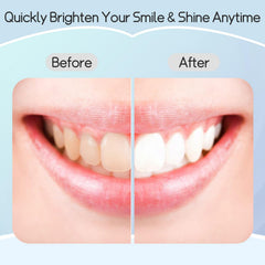 Before and after whitening results
