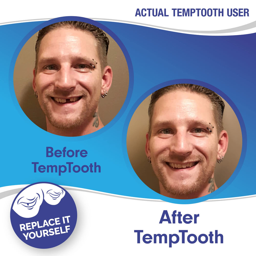 Temporary tooth snapped into place without cement