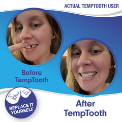 Bead molded into a natural-looking temporary tooth