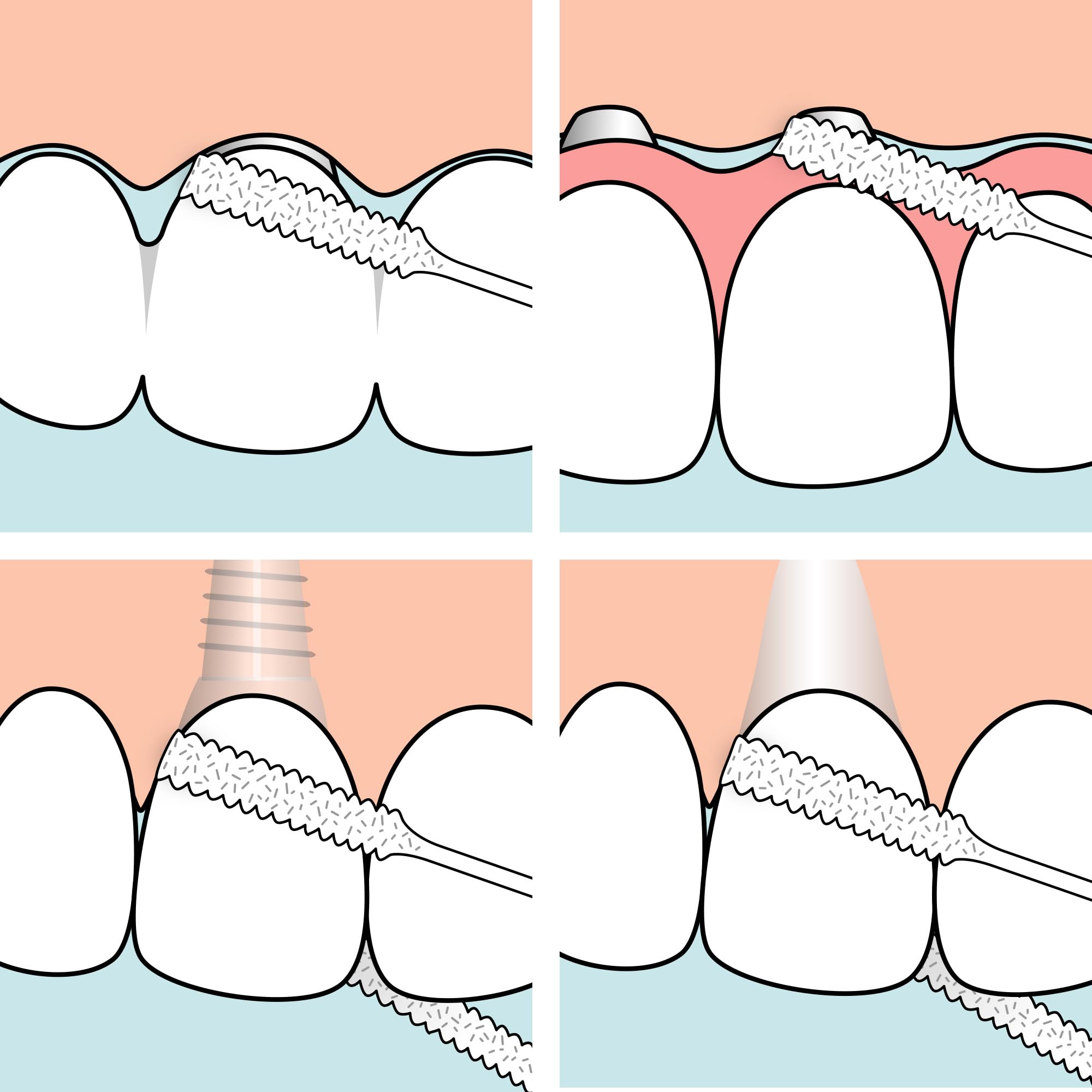 Open interdental space with floss threading