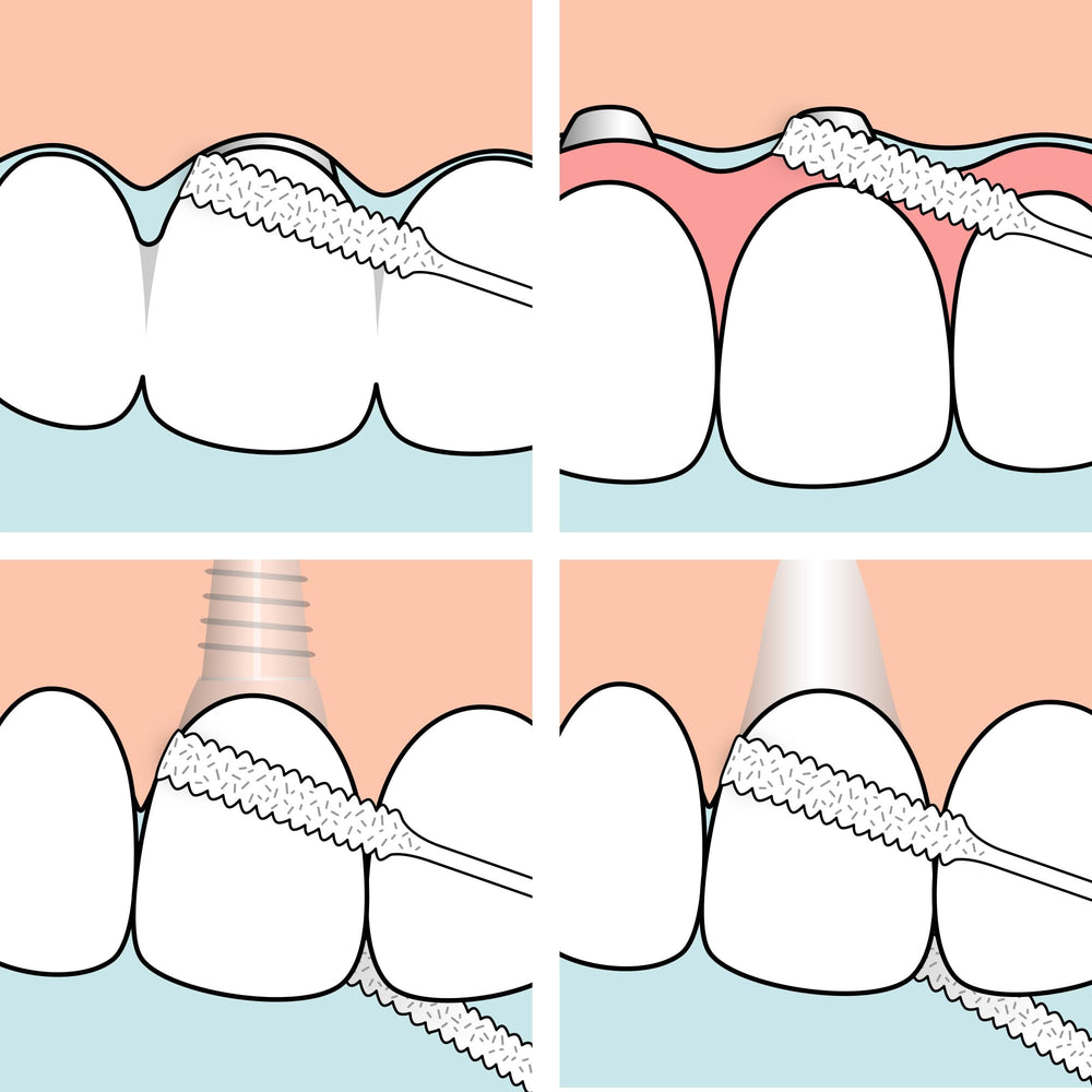 Open interdental space with floss threading