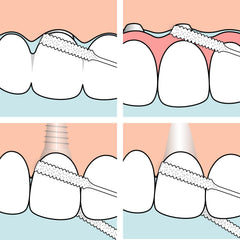Open interdental space with floss threading