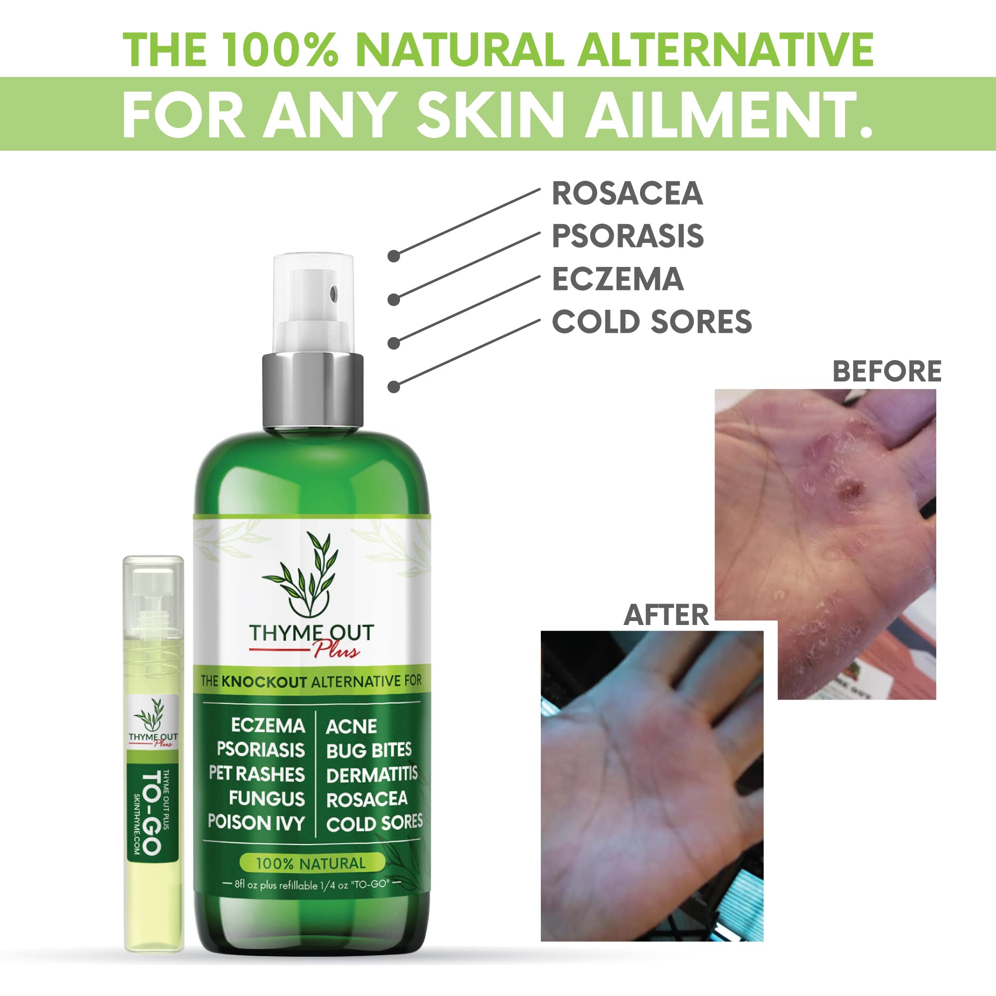 Thyme Out Plus psoriasis-care spray helps calm flare-ups with natural ingredients