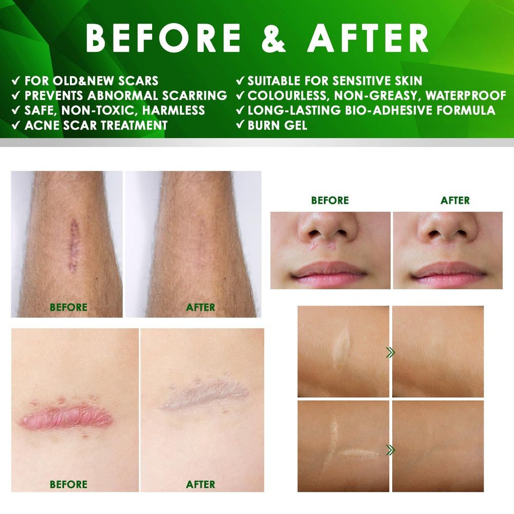 Tobcharm silicone scar sheets synergy; gel helps soften tissue and boost sheet results.