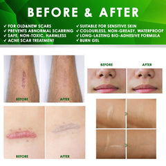 Tobcharm silicone scar sheets synergy; gel helps soften tissue and boost sheet results.