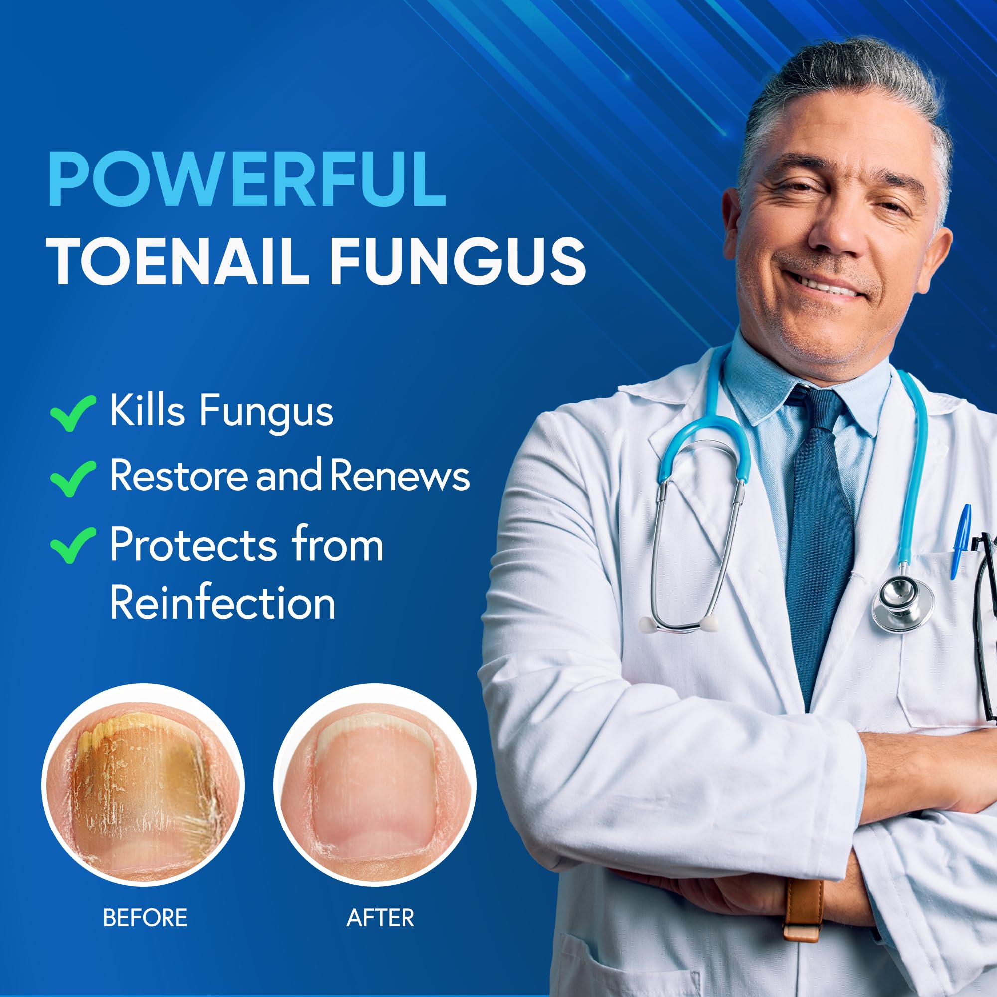 Tobcharm Toenail Fungus Treatment bottle-right focus highlights dual-bottle setup for extra strength.