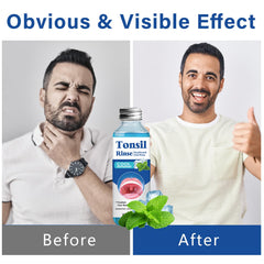 Portable 120 ml bottle of Tonsil Stone Remover Mouthwash