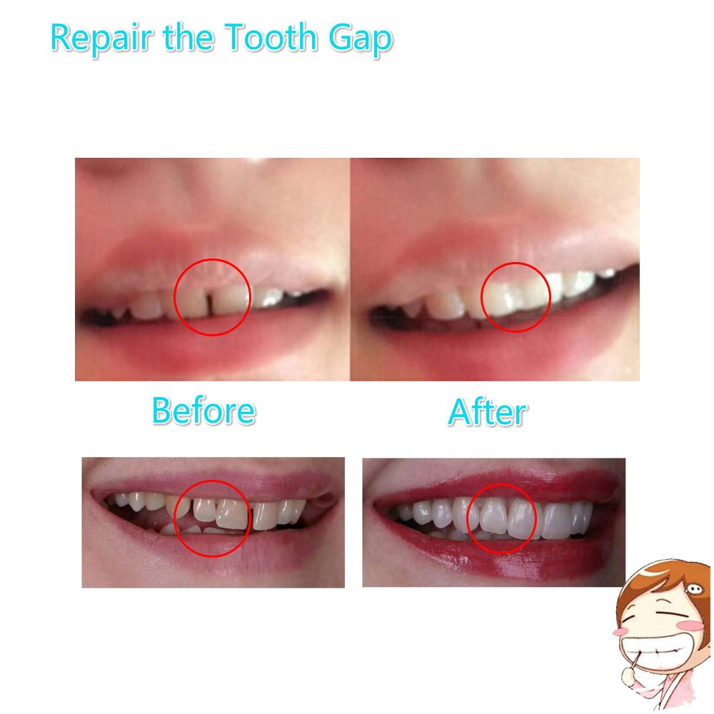 Close-up of shaping a temporary tooth from the kit