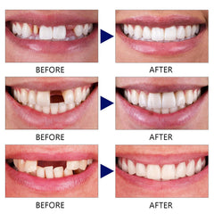 Filled tooth securely in place after cooling