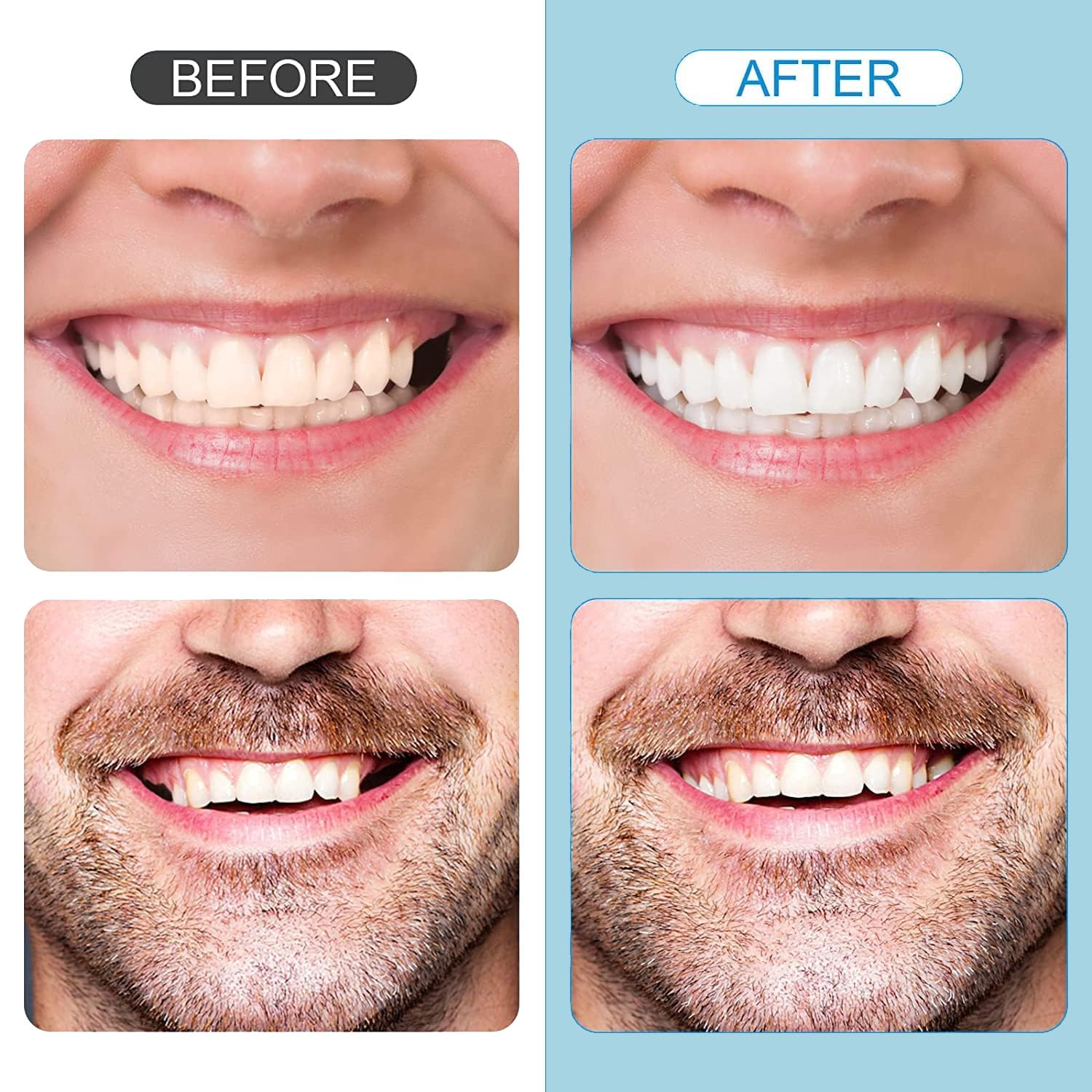DIY temporary tooth restoration kit for at-home use