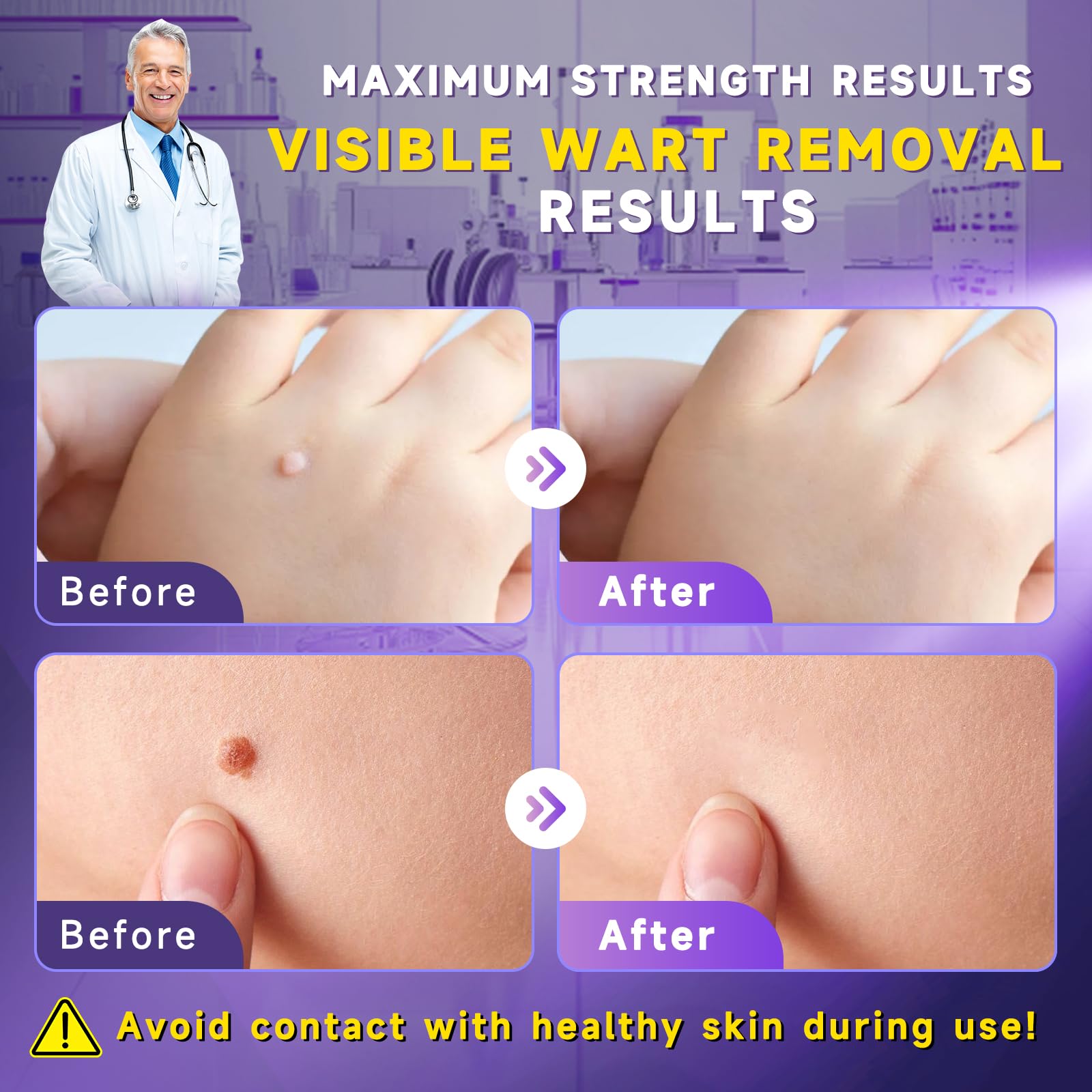 TTsiya Wart Remover Cream targets plantar warts on the bottom of the foot.