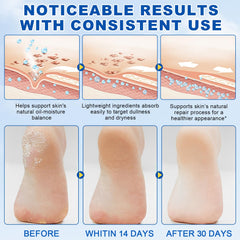 Urea Foot Cream 60% leaves feet non-greasy and comfortable.
