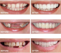 User-friendly cleaning and preparation of aligners