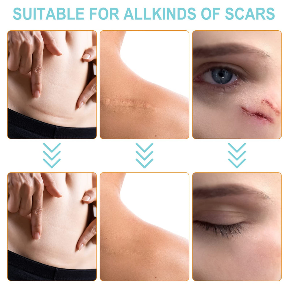 Vortexonix silicone scar sheets worn for 24 hours showing breathable comfort