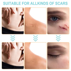 Vortexonix silicone scar sheets worn for 24 hours showing breathable comfort
