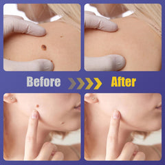 WABRINY wart remover patch application area demonstrates easy use