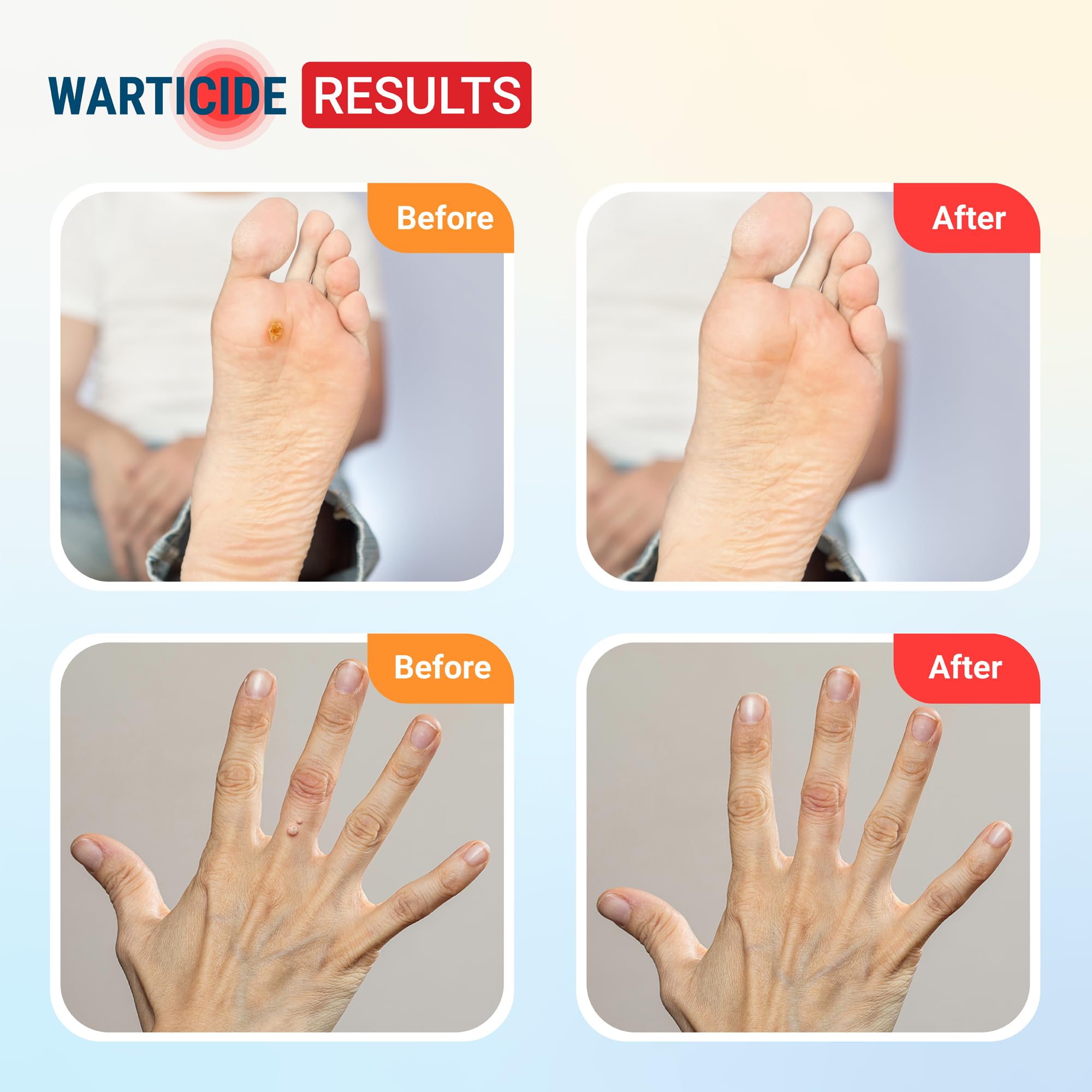 Warticide liquid wart remover dropper applying the treatment precisely to skin.