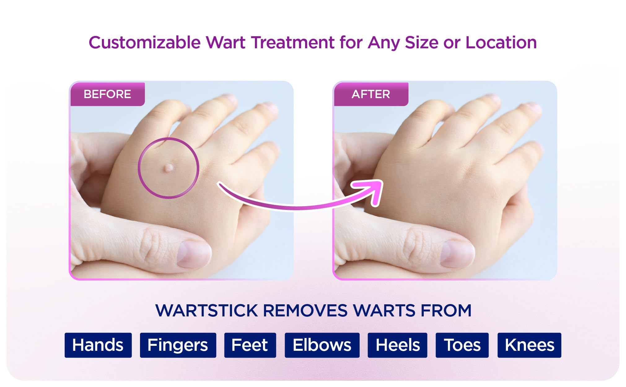 WartStick solid-stick application closeup highlights clean, mess-free wart treatment.