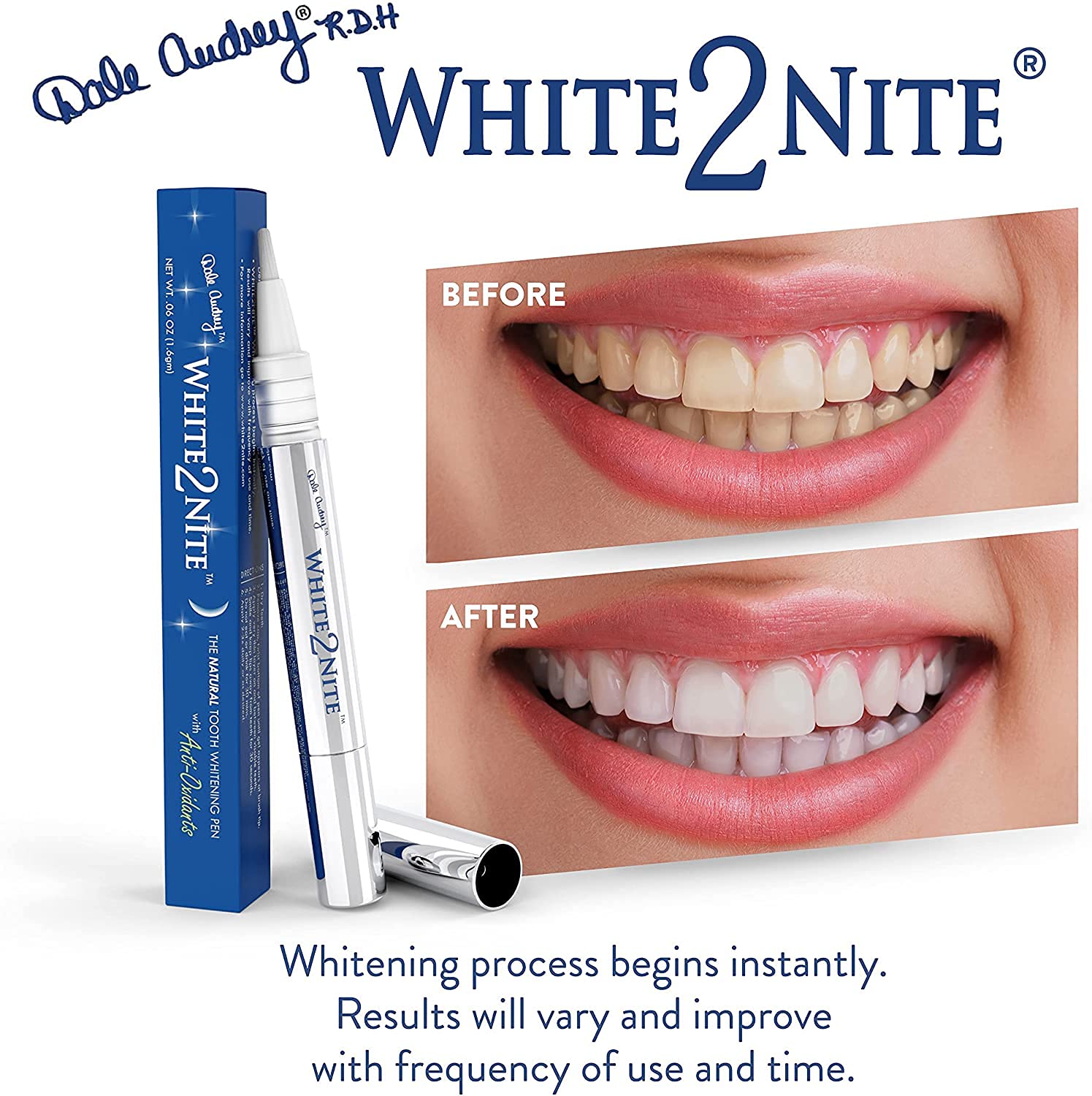 Before stain removal with White2nite whitening pen