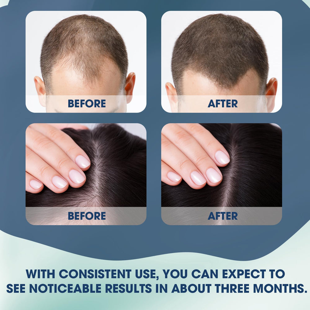 Xaninp Hair Growth Serum Roll-On applied to thinning areas for targeted nourishment.