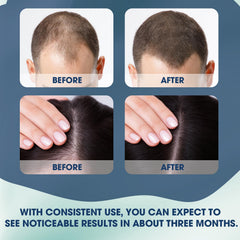 Xaninp Hair Growth Serum Roll-On applied to thinning areas for targeted nourishment.