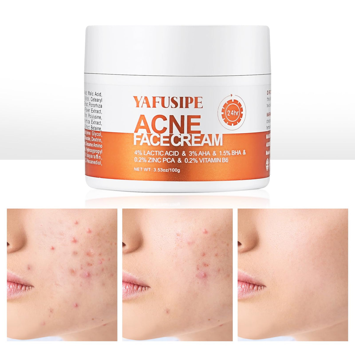 YAFUSIPE acne treatment cream tube for targeted breakout care