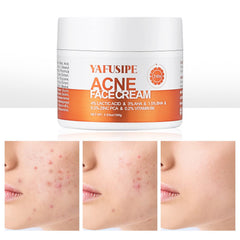 YAFUSIPE acne treatment cream tube for targeted breakout care