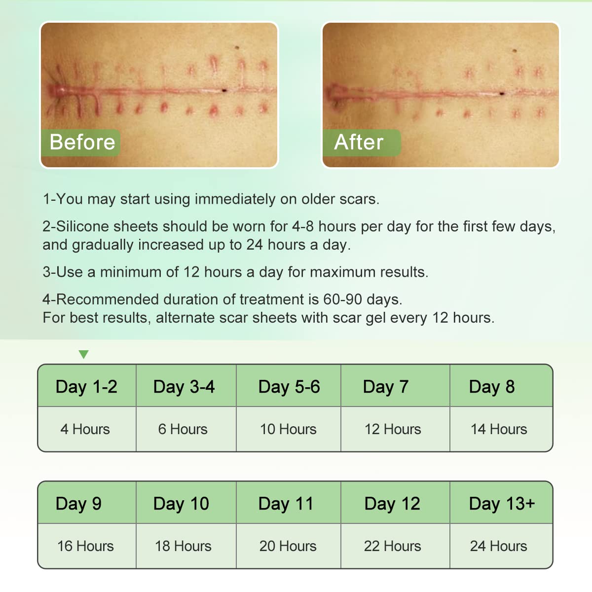 ZODENIS silicone scar sheets for C-section scar demonstrating gentle adhesion