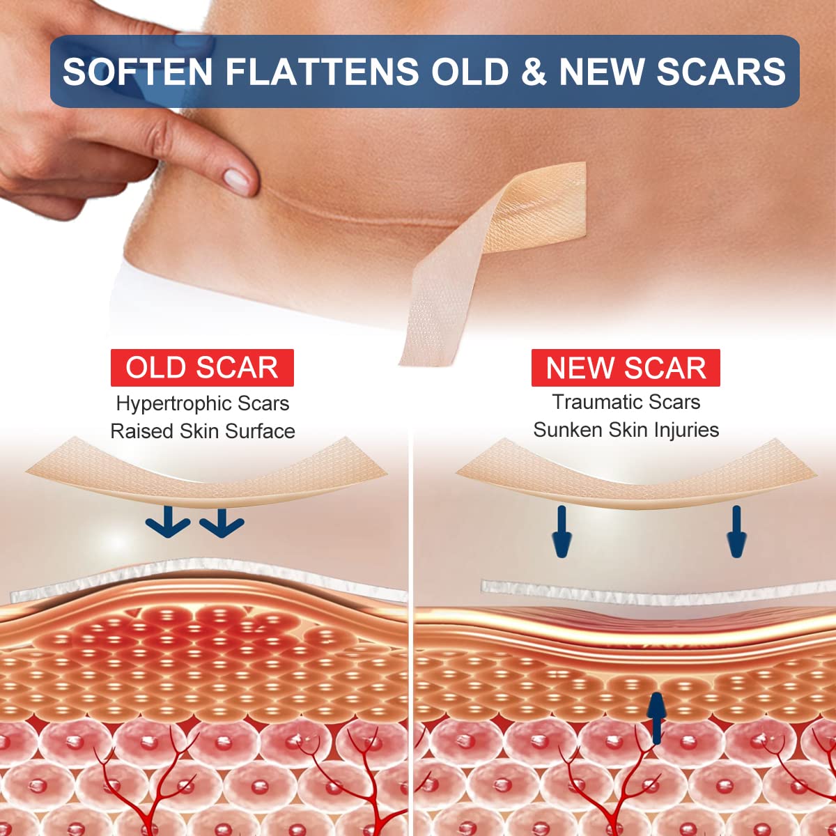 ZODENIS silicone scar sheets cut-to-length show flexible fit for various scars