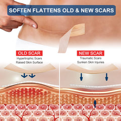ZODENIS silicone scar sheets cut-to-length show flexible fit for various scars