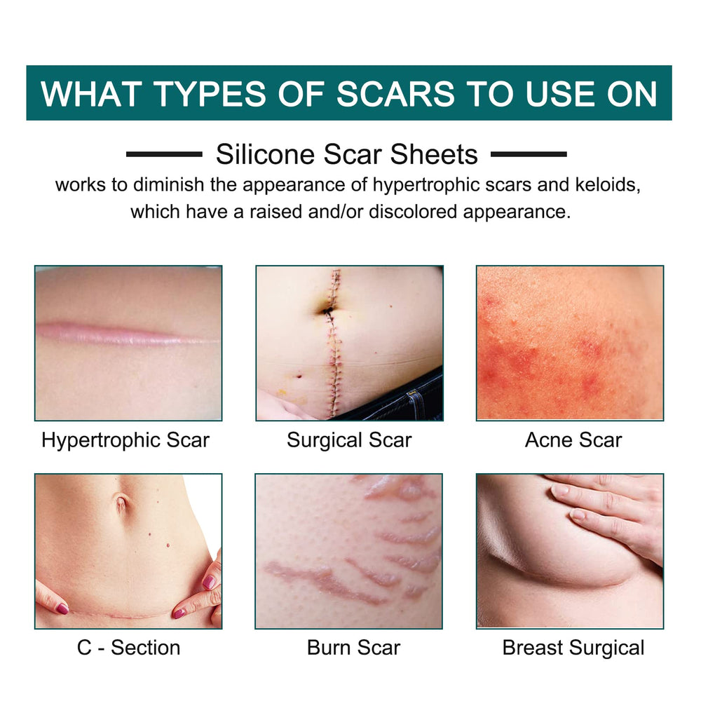 ZODENIS silicone scar sheets on skin demonstrate repositionable coverage for delicate scars