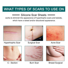 ZODENIS silicone scar sheets on skin demonstrate repositionable coverage for delicate scars