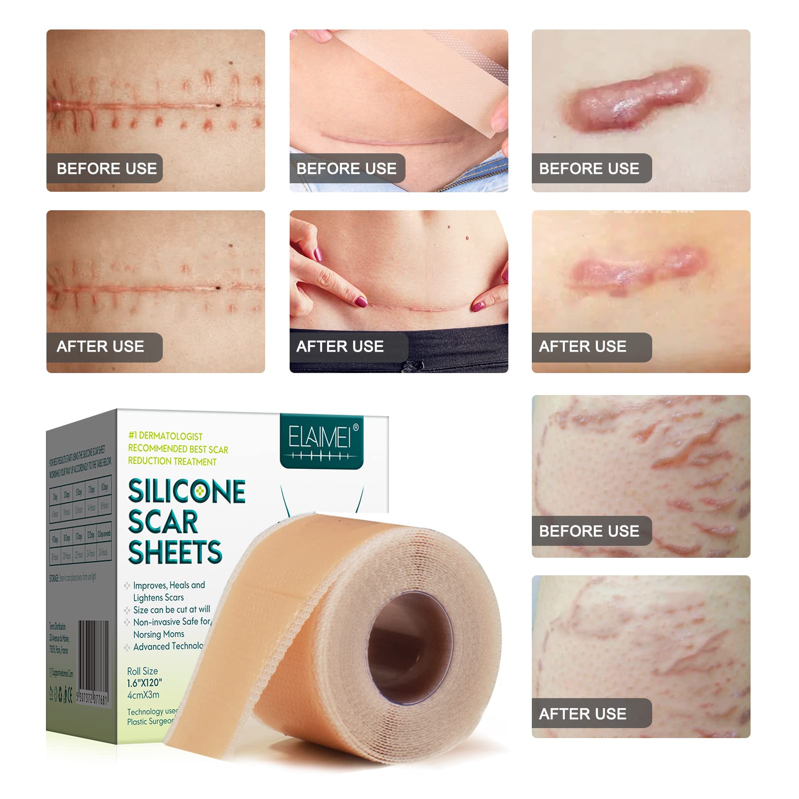 ZODENIS silicone scar sheets for children showing safe, gentle coverage