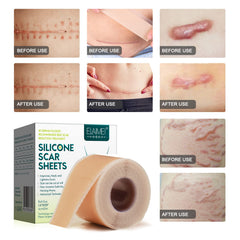 ZODENIS silicone scar sheets for children showing safe, gentle coverage
