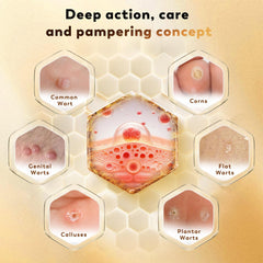 Zozdal bee venom wart remover applicator for quick at-home sessions