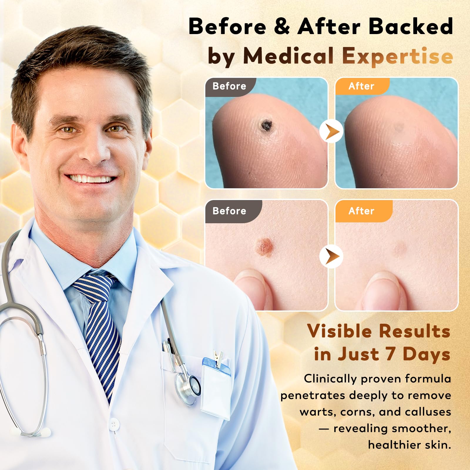 Zozdal bee venom wart remover ingredients highlight salicylic acid and bee venom